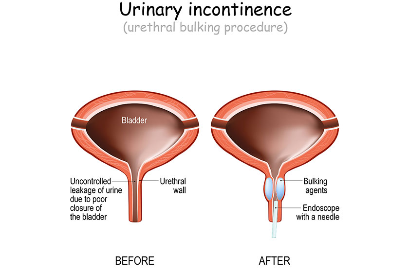 How Charlotte NC Assisted Living Can Help Seniors With Incontinence