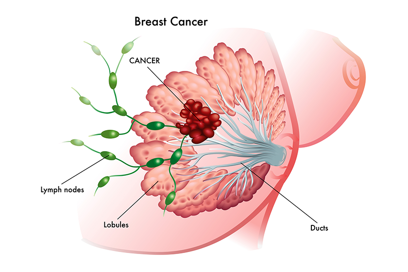 Recognizing Early Signs Of Breast Cancer In Seniors | TerraBella